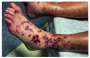 imagenes_comentadas:leukocytoclastic_vasculitis_after_covid-19_vaccine_booster.png